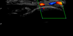 Finger peripheral vessel