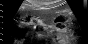 Intraductal pancreatic mucinous neoplasm