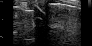Knee (DJD with femoral spur, bulging of medial meniscus)