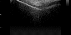 Knee (femoral articular cartilage)