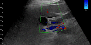 Liver portal-hepatic shunt