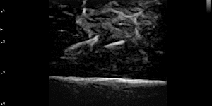 Needle guided aspiration