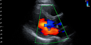 Parasternal long-axis view