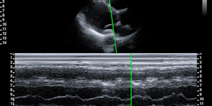 Parasternal long-axis view