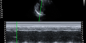 Parasternal short-axis view