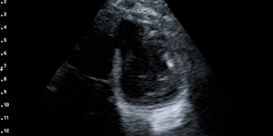 Parasternal short-axis view
