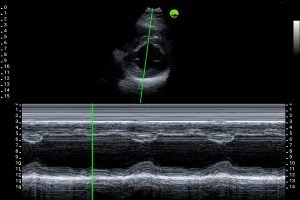 Parasternal short-axis view
