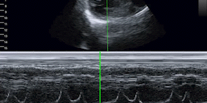 Parasternal short-axis view