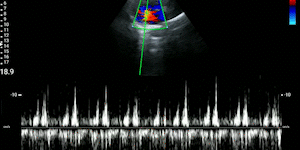 Parasternal short-axis view