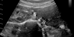 Polycystic ovarian syndrome with follicles