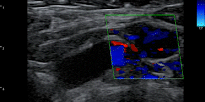 Post-vaccination axillary lymph node hyperplasia