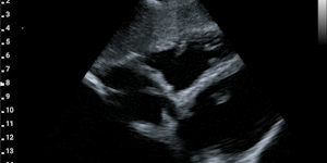 Subcostal 4 chambers view