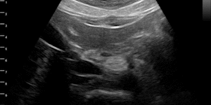 Upper abdomen (celiac trunk)