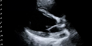 Parasternal long-axis view