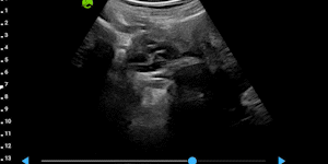 Polycystic ovary disease