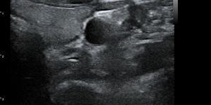 Thyroid hypertrophic follicle